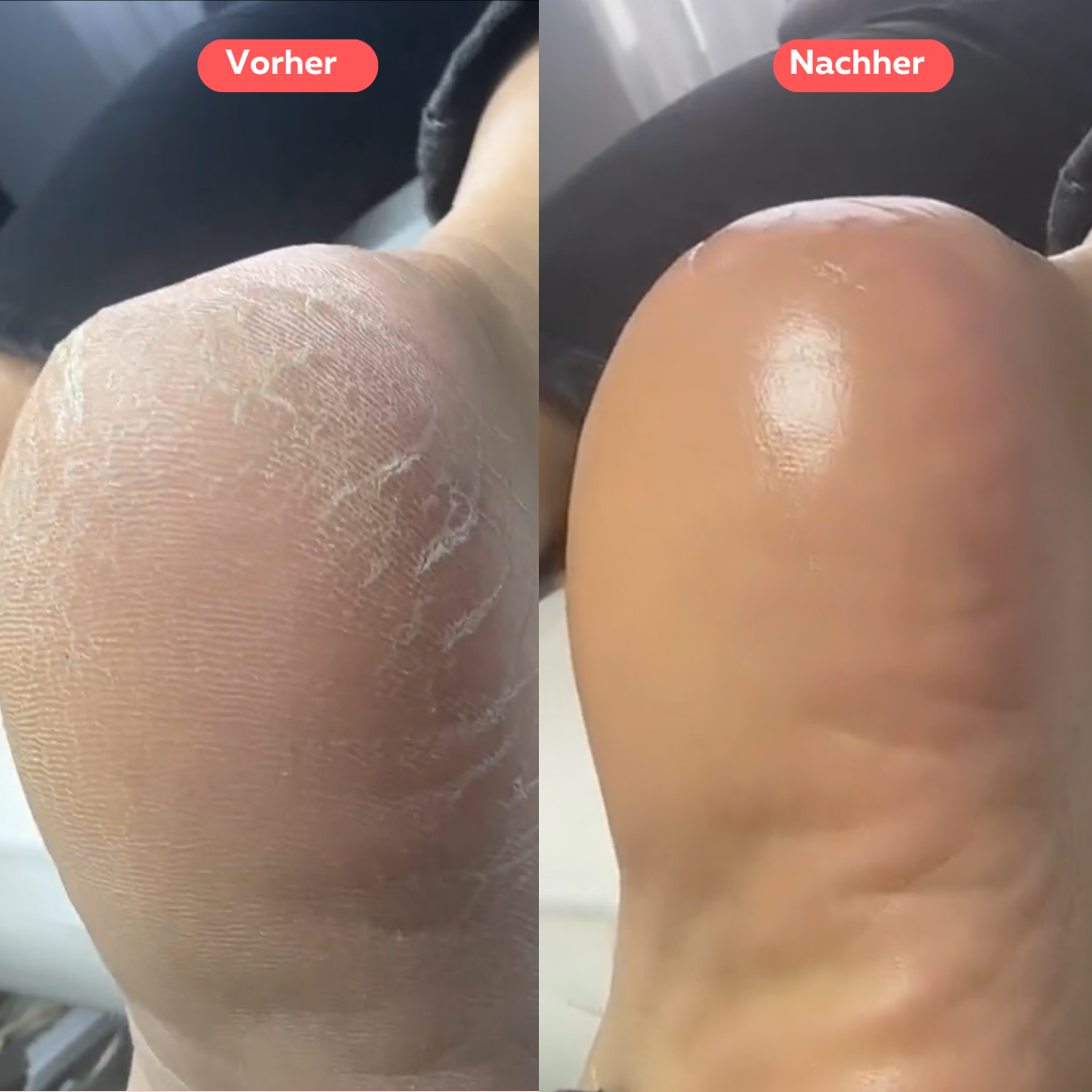 Nuvira ¦ Hornhautentferner
